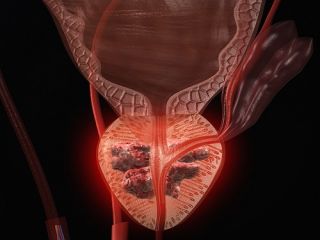 ۱۰ عامل خطرآفرین برای سرطان پروستات