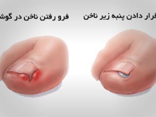 وقتی ناخن پا در گوشت فرو می رود