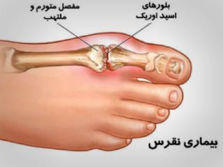 راه های کاهش اسید اوریک بالا