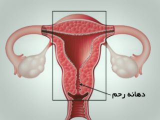 چه موقع برداشتن رحم لازم است؟