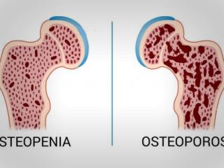 چگونگی پیشگیری از پوکی استخوان