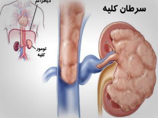 نشانه های پنهان سرطان کلیه