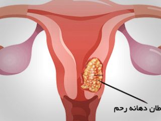 علائم سرطان دهانه رحم