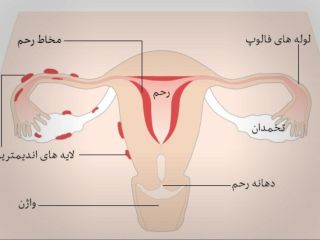 اندومتریوز؛ تمام شکم و لگن پریود می‌شود