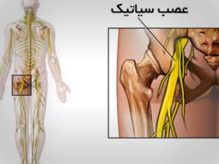 ۱۰ روش درمان درد سیاتیک