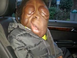 تومور بدخیم باعث تغییر شکل عجیب پسر ۸ ساله شد