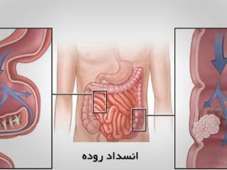 بیماری انسداد روده خطرناک است