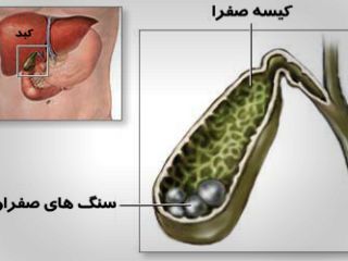 سنگ صفرا درمان دارویی ندارد