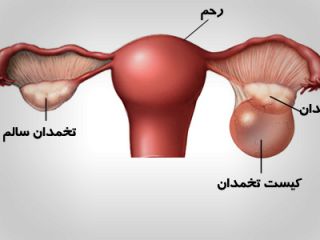 آیا کیست تخمدان با طب سنتی قابل درمان است + ۲ نسخه ساده درمانی