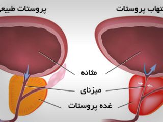 پروستاتیت چیست؟