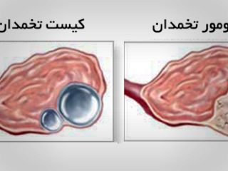 تفاوت‌های تومور با کیست