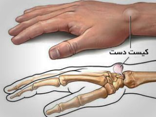 بیشتر کیست‌ها خطری ندارند