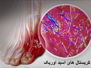 طب سنتی درباره نقرس چه می‌گوید؟