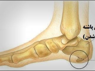 خار پاشنه را چگونه درمان کنیم؟