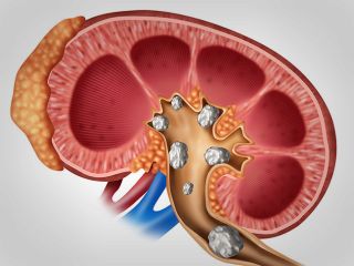 دلایل ابتلا به سنگ کلیه از دیدگاه طب سنتی