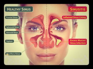 آبریزش و گرفتگی بینی مهمترین علامت سینوزیت
