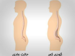 عدم درمان یبوست باعث ابتلا به گودی کمر