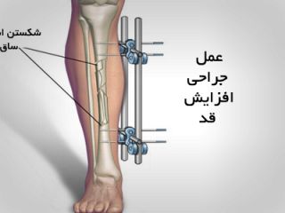 قدبلندهای ساختگی