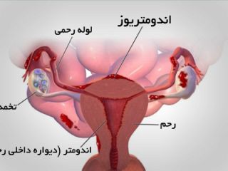 درد قاعدگی بعد از روز سوم را جدی بگیرید