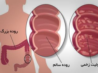 وقتی دیواره روده زخم می‌شود