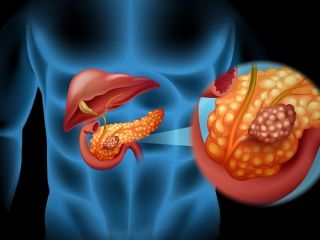 این ۶ نشانه سرطان لوزالمعده را نادیده نگیرید