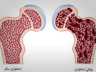 انواع پوکی استخوان و راه‌های درمان