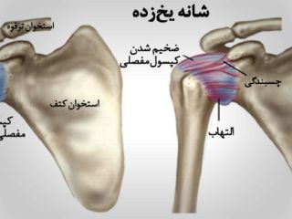 «شانه‌ یخ زده» علت و راه های درمان آن