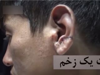 کودک گوش بریده: گوشم را باربند ماشین زخمی کرده/ با تهدید مجبورم کردند بگویم ماموران شهردای گوشم را بریده‌اند - ویدیو