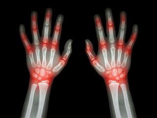 آرتریت روماتوئید و آرتروز چه تفاوتی با هم دارند؟