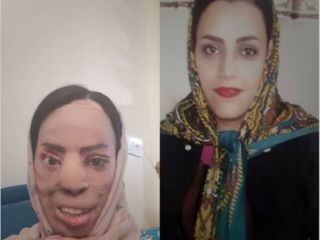 اسیدپاشی عروس به روی خواهرشوهر