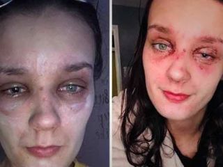 بلایی که تخم مرغ آب پز بر سر دختر ۱۹ ساله آورد