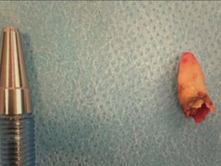 دماغ یک مرد دانمارکی دندان درآورد!