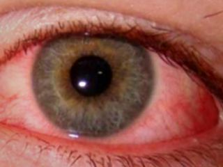 محققان: عارضه چشم صورتی نشانه ویروس کروناست