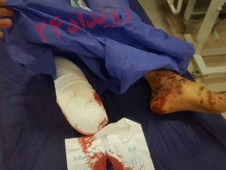 روایت قطع پای کودک ۱۲ ساله در اهواز/ پدر مهدی: قبول نمی‌کردند مین بوده، می‌گفتند بچه‌ات ترقه بازی کرده است