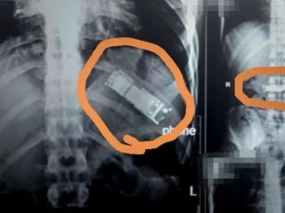 این موبایل ۷ ماه در معده یک جوان مصری باقی مانده بود
