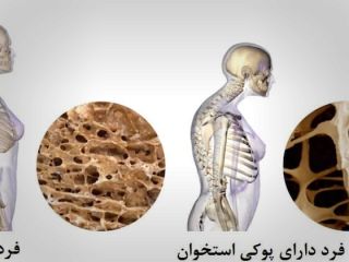 سالم‌ترین عادات برای جلوگیری از بیماری خاموش استخوان‌ها