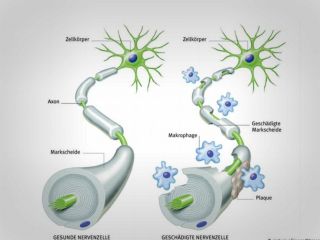 ام‌اس؛ یک عارضه با هزار و یک افسانه