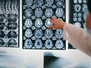 ابداع روش تشخیص نشانه‌های اولیه آلزایمر با دقت ۱۰۰ درصدی در لیتوانی