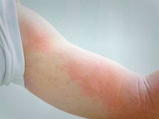 چطور دچار کهیر خورشیدی  نشویم؟