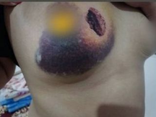 جراحت شدید سینه دختر ۲۰ ساله در اثر شلیک گاز اشک آور