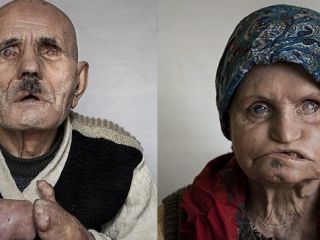 (تصاویر) بیماران جذامی در مجتمع درمانی بابا باغی