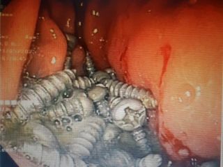 خارج کردن ۴۷ پیچ فلزی از معده یک بیمار در کرج