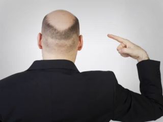 محققان اسپانیایی یک روش درمانی انقلابی برای طاسی یافتند