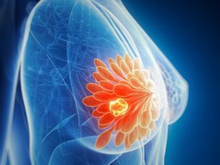 پستان مانجارو؛ داروهای کاهش وزن می‌توانند توده‌های سرطانی را کوچک کنند