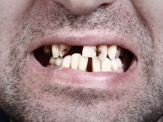 «ایران کشور بی‌دندان‌ها»؛ لبخندهای فروخفته، دندان‌های خراب و جیب‌های خالی