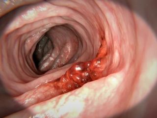 با علائم اولیه سرطان روده بزرگ، دومین عامل مرگ و میر در اثر سرطان آشنا شوید