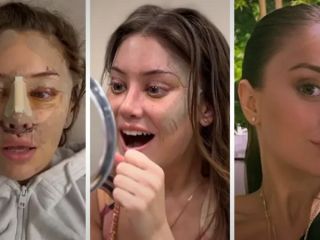 لیفت صورت در ۲۸ سالگی؟ چرا جوان‌ها به جراحی زیبایی روی آورده‌اند؟