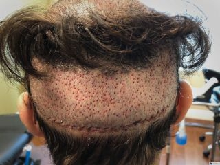 همه چیز درباره رابطه جنسی بعد از کاشت مو