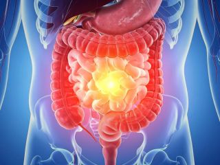 داروهای لاغری نرخ مرگ در اثر سرطان روده را کاهش دادند