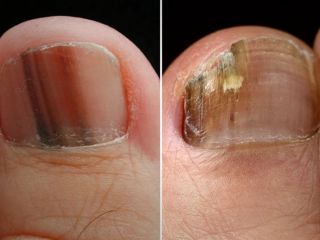 هر آنچه که ناخن‌های پا در مورد سلامتی به ما می‌گویند؛ از تغییر رنگ و شکل تا بیماری!